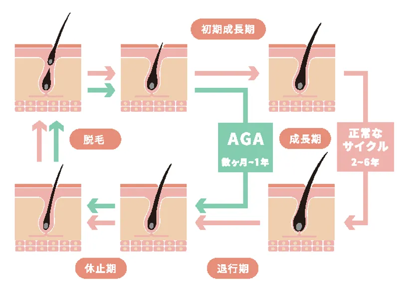 AGAの原因と進行の特徴